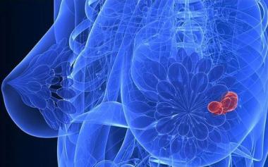 警惕！乳腺癌术后有两个复发高峰期！日常如何预防？