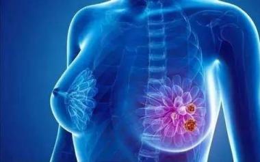 新冠肺炎疫情期间，乳腺癌患者如何治疗与预防？