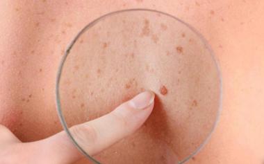 澳洲研究人员发现防晒降低皮肤癌风险的作用机制