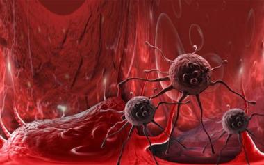 新证据表明癌组织中藏有细菌 治疗癌症需同时“抗炎抑菌”
