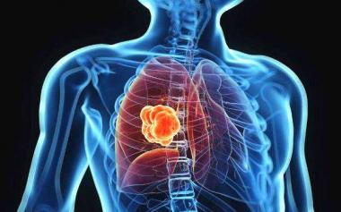 最新研究：有肺癌家族史的人患肺癌风险增加85%