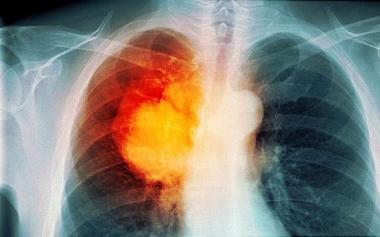 权威发布：40岁后肺癌发病率急剧上升，多数患者由吸烟引起