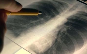 江苏一银行现“群体性肺结节”！肺结节离肺癌到底有多远