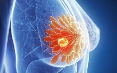 女性乳腺癌成为全球确诊数量最多的癌症！谁是高危人群？