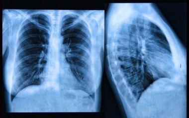 为啥肺癌查出多是晚期？其实4个呼吸道异常表现早已提醒你